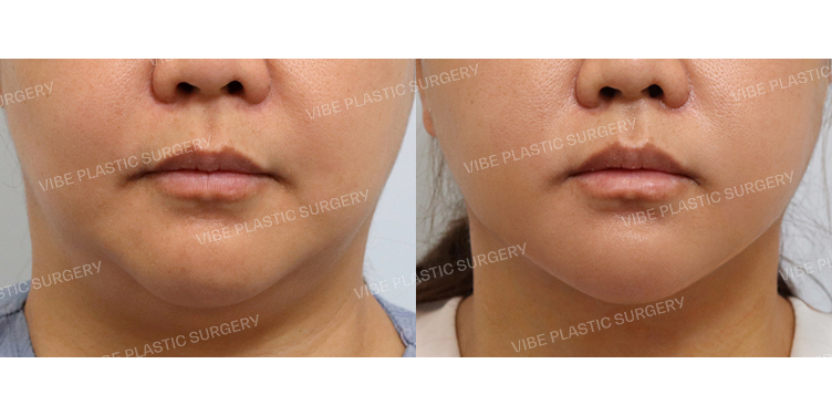 #초음파지방흡입 #목거상(이중턱근육묶기)