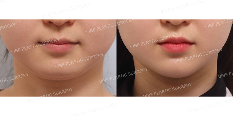 #초음파지방흡입(이중턱,턱라인)