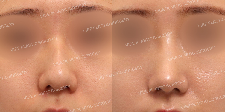 #무보형물 #매부리코 #긴코 #휜코