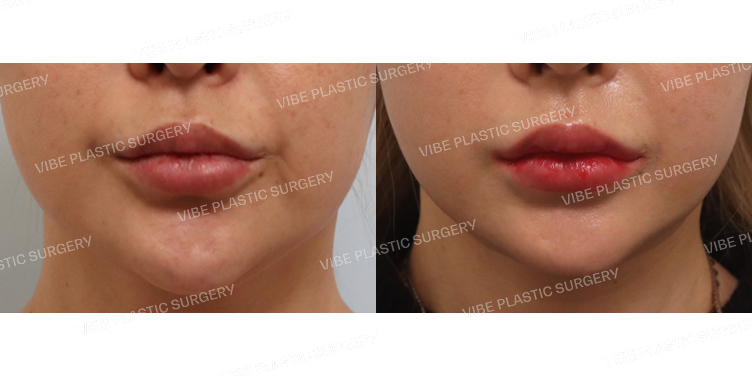 #초음파지방흡입(이중턱,턱라인) #실리프팅