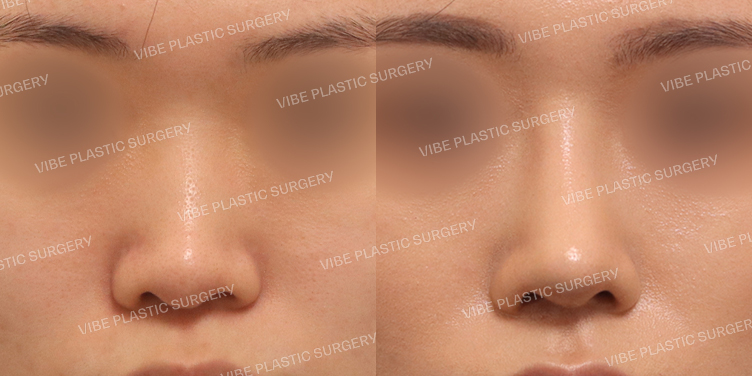 #낮은코 #매부리코