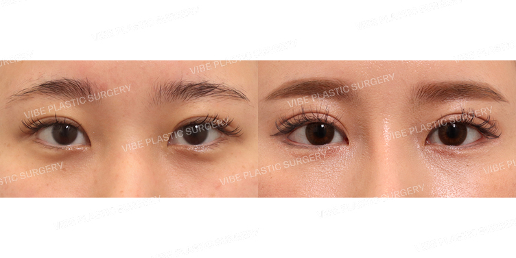 #자연유착(재수술) #뒤밑트임(재수술)