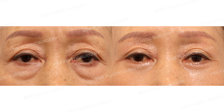 #중년눈성형 #눈썹밑거상술 #하안검성형
