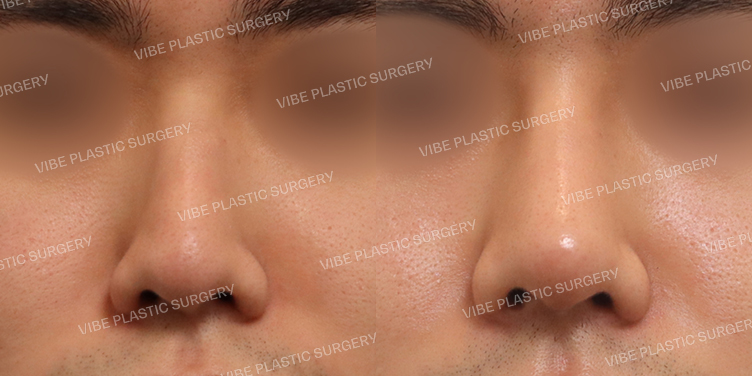 #매부리코 #휜코 #긴코