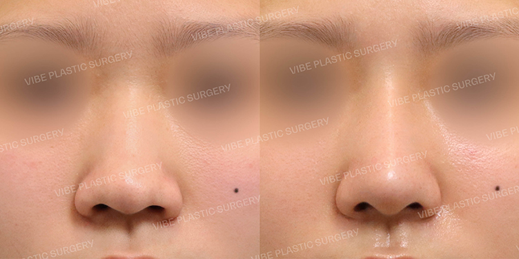 #매부리코 #복코 #절골 #비중격연장이식 #비순각교정