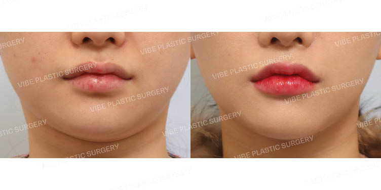 #초음파지방흡입(이중턱&턱라인) #심부볼지방제거