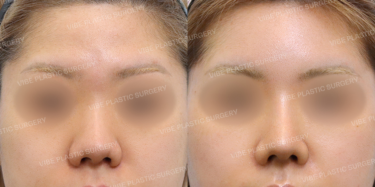 #지방이식 #코끝 #복코 #실리콘보형물