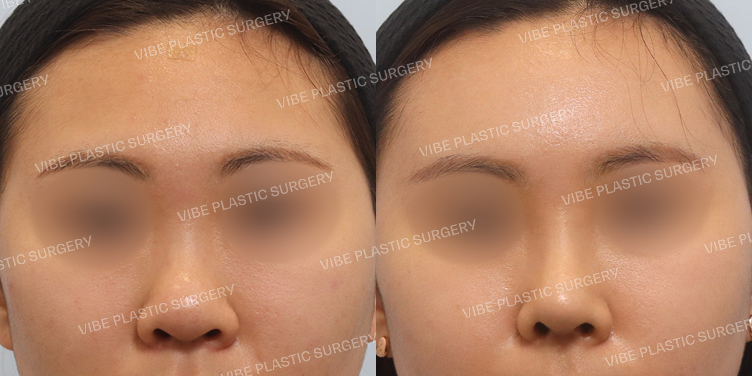 #복코 #이마지방이식