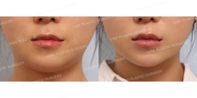 #초음파지방흡입(이중턱,턱라인)