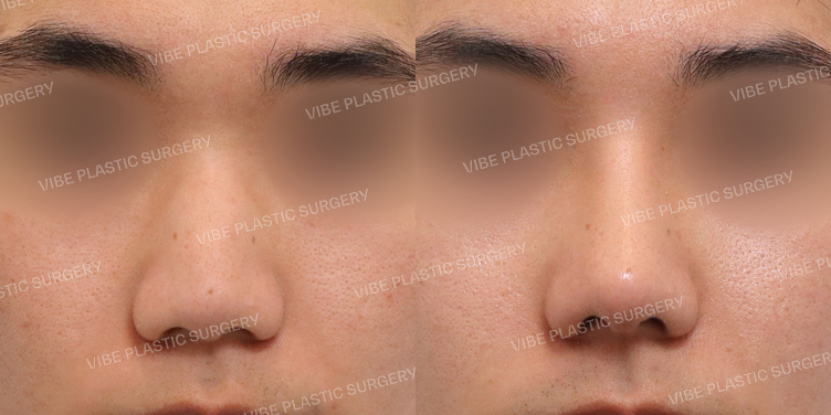 #남자코 #매부리코 #복코 #절골