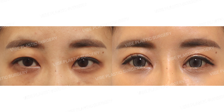 #절개눈매교정 #위트임