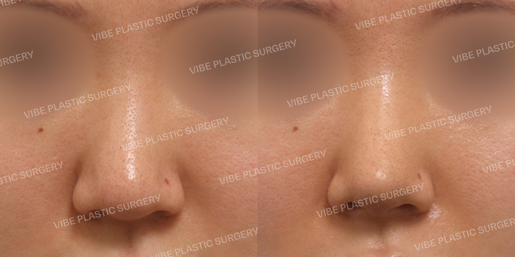 #복코 #긴코 #절골(재수술)