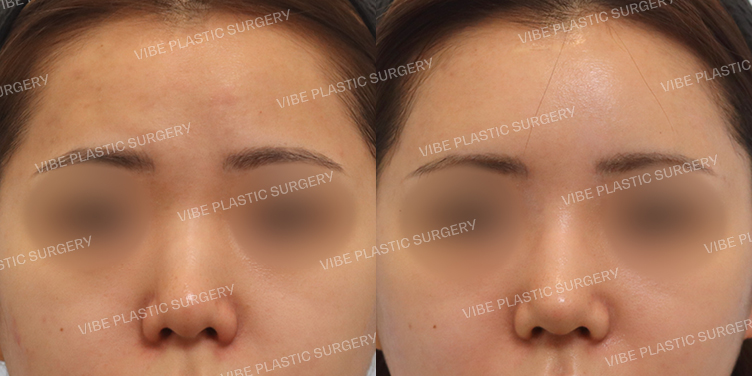 #이마지방이식 #매부리코 #낮은코 #복코