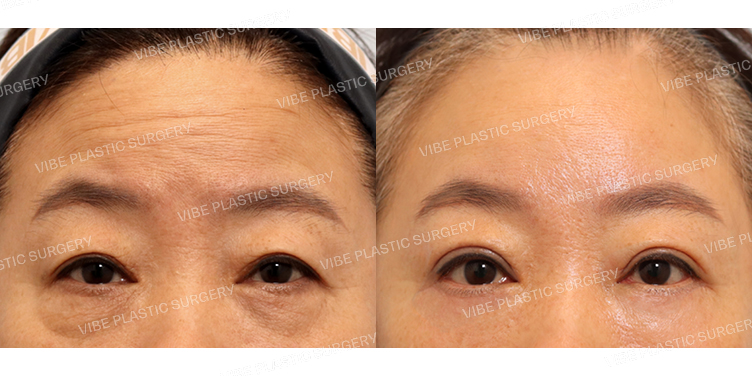 #상안검 #하안검 #내시경이마거상