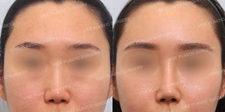 #낮은코 #이마지방이식