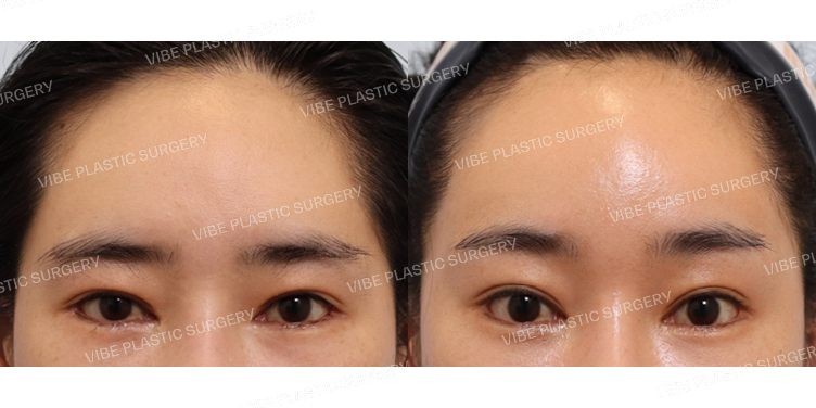 #내시경이마거상