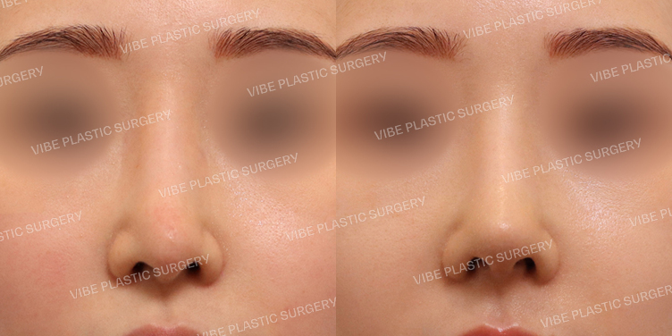 #3번째코재수술 #긴코 #휜코