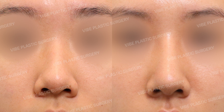 #매부리코 #복코