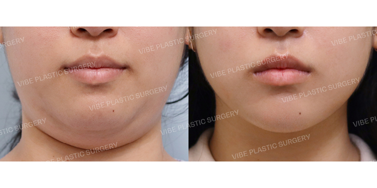 #초음파지방흡입(이중턱,턱라인) #턱끝필러