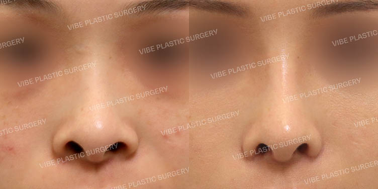 #비공내리기 #비주교정 #콧볼축소