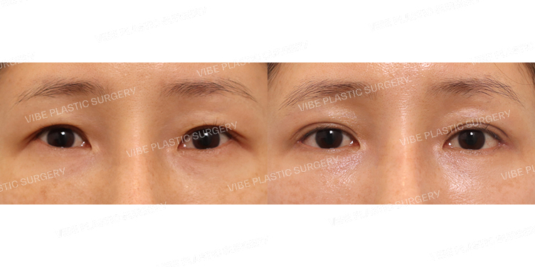 #상안검(재수술) #뒤트임 #밑트임