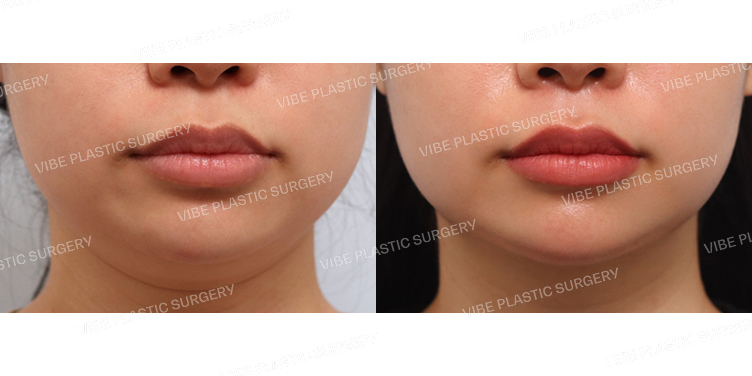 #초음파지방흡입(이중턱,턱라인)