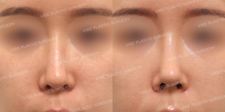 #무보형물 #코끝