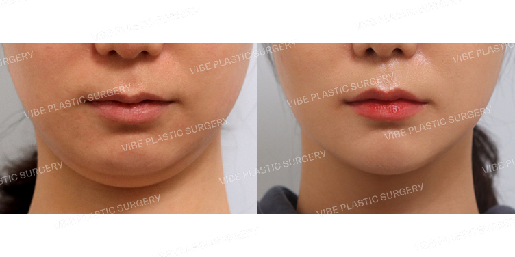 #리포사운드지방흡입(이중턱)