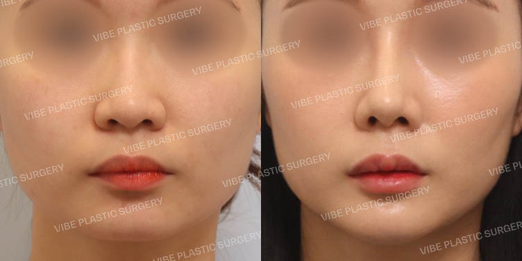 #낮은코 #매부리코 #턱끝보형물(무턱교정)