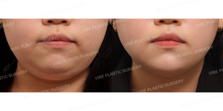 #초음파지방흡입(이중턱,턱라인) #턱끝필러 #턱보톡스