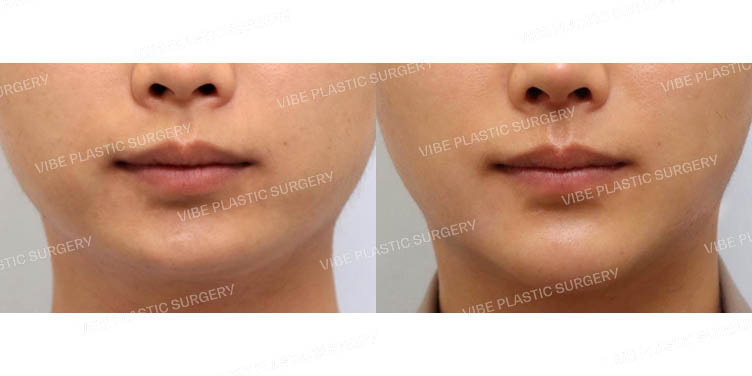 #초음파지방흡입(이중턱,턱라인) #심부볼지방제거 #턱끝보형물