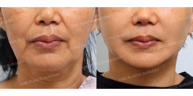 #절개안면거상 #목거상