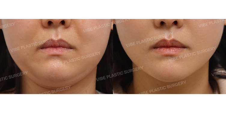 #초음파지방흡입(이중턱,턱라인,앞볼) #이중턱실리프팅