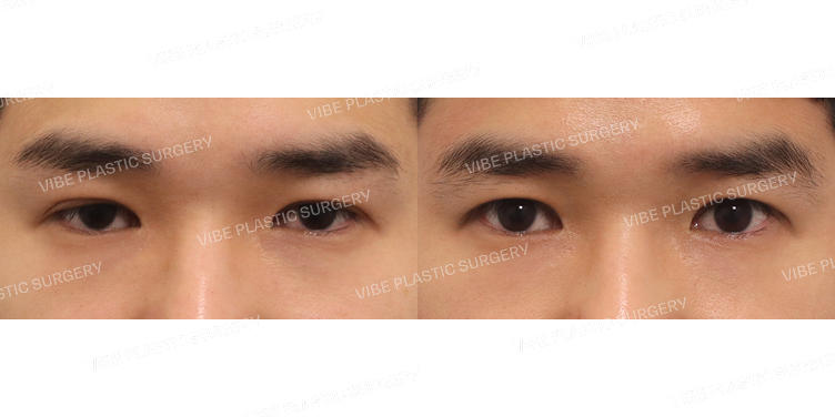 #절개눈매교정(3번째재수술)