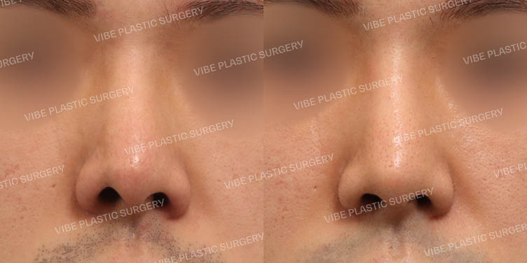 #비공내리기(오른쪽)