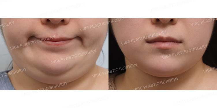 #실리프팅 #턱끝필러 #슈링크 #초음파지방흡입(이중턱,턱라인,앞볼)