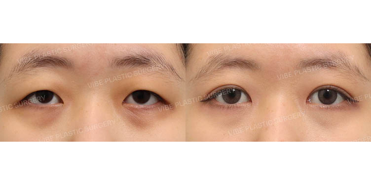 #부분절개눈매교정 #앞트임