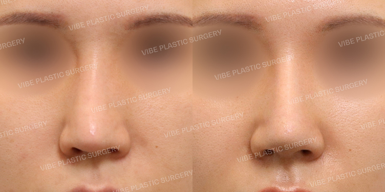 #3번째코재수술 #보형물교체 #휜코 #긴코 #자가늑