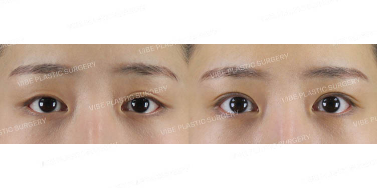 #비절개눈매교정