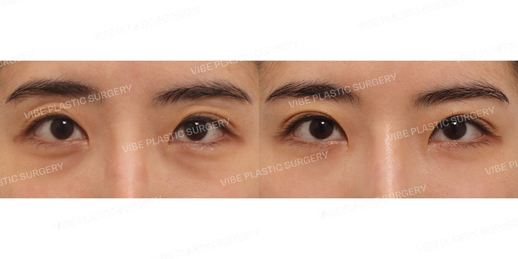 #절개눈매교정(재수술) #눈밑지방재배치