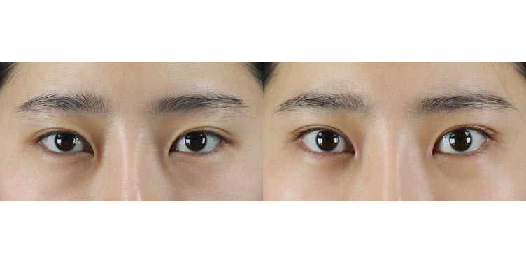 #부분절개눈매교정 #앞트임 #눈밑지방재배치