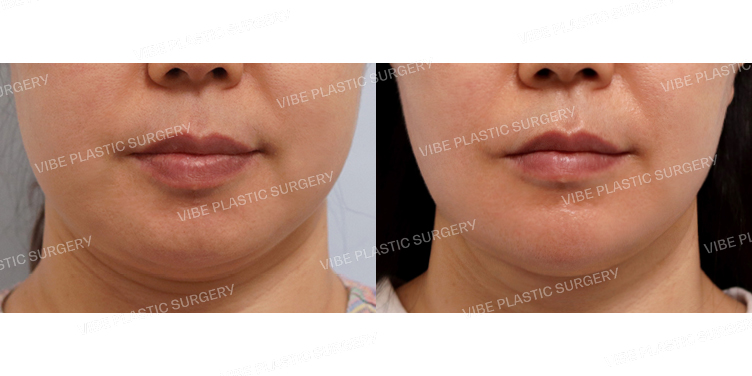 #리포사운드지방흡입 #실루엣리프팅