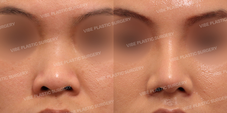 #짧은코 #복코 #콧볼축소