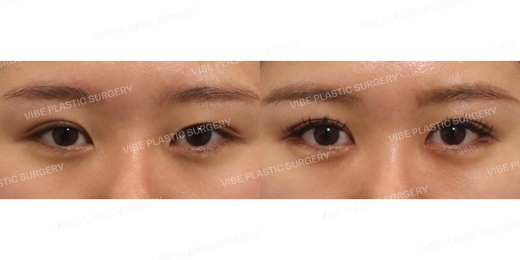 #자연유착(재수술) #앞트임 #뒤트임 #밑트임