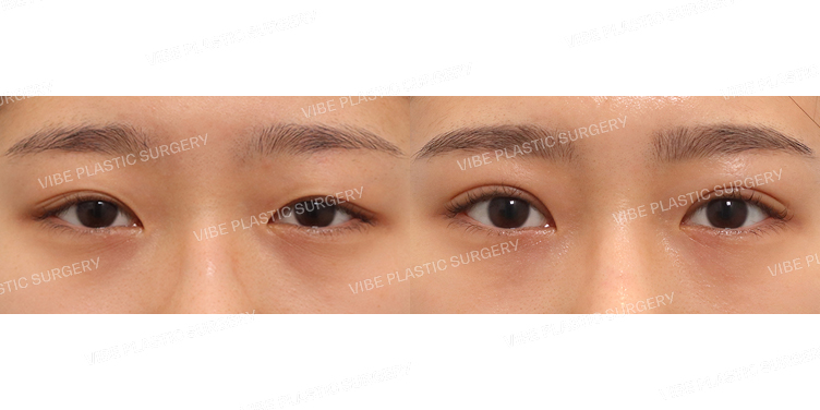 #부분절개눈매교정