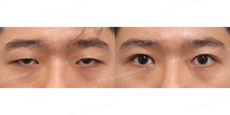 #부분절개눈매교정 #앞트임