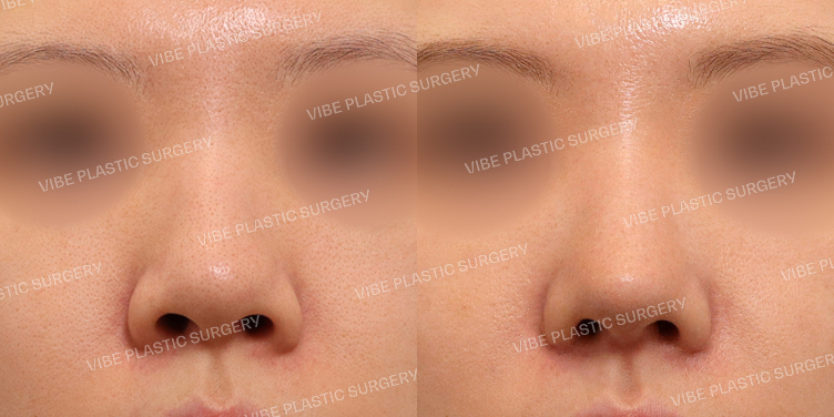 #무보형물 #복코 #매부리코 #비순각교정 #콧볼축소