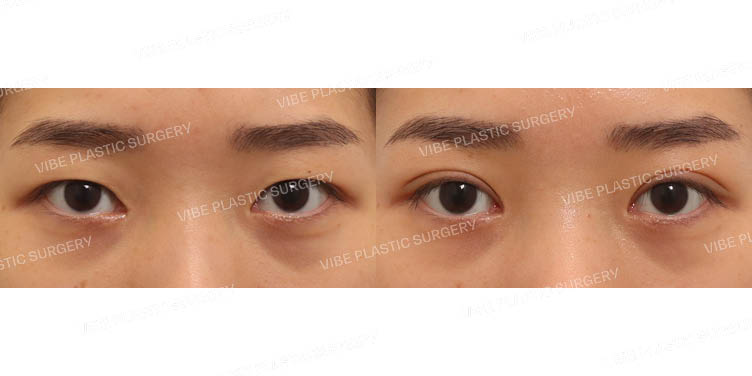 #절개눈매교정(재수술)