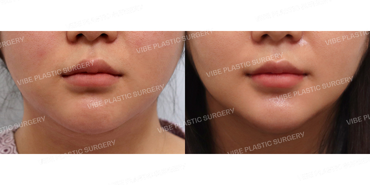 #초음파지방흡입(이중턱,턱라인)