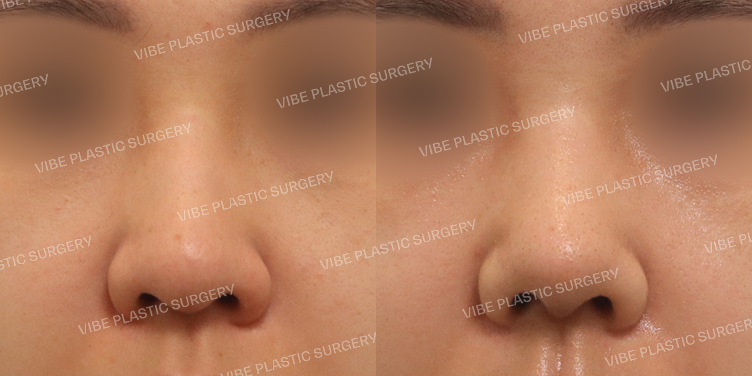 #무보형물 #매부리코 #긴코 #복코